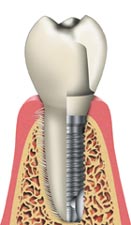 Implant Illustration